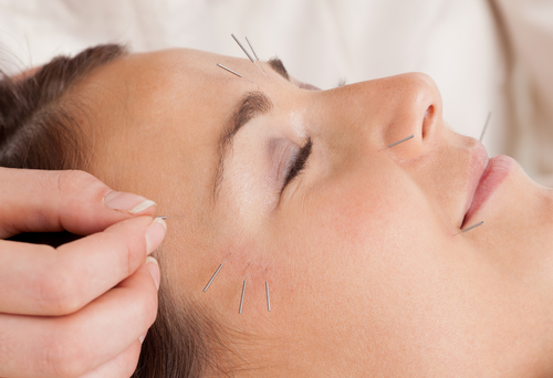 Facial acupuncture treatment at MIRA Integrative Clinic