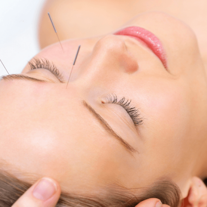 Cosmetic facial acupuncture treatment at MIRA Integrative Clinic
