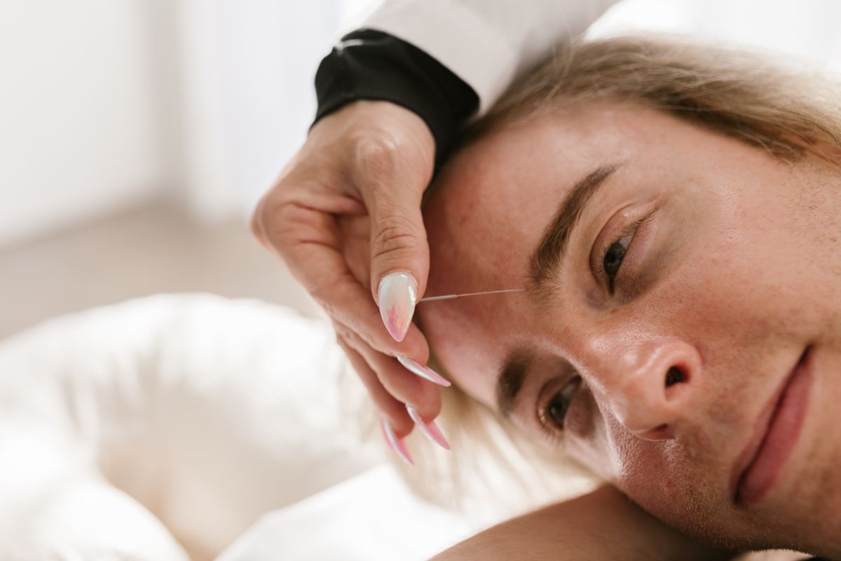 Cosmetic facial acupuncture