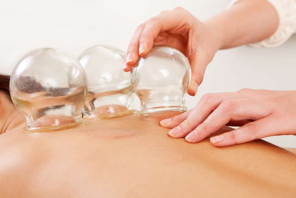 Traditional glass cupping therapy on the back at MIRA Integrative Clinic