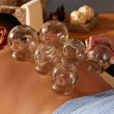 Traditional cupping therapy at MIRA Integrative Clinic