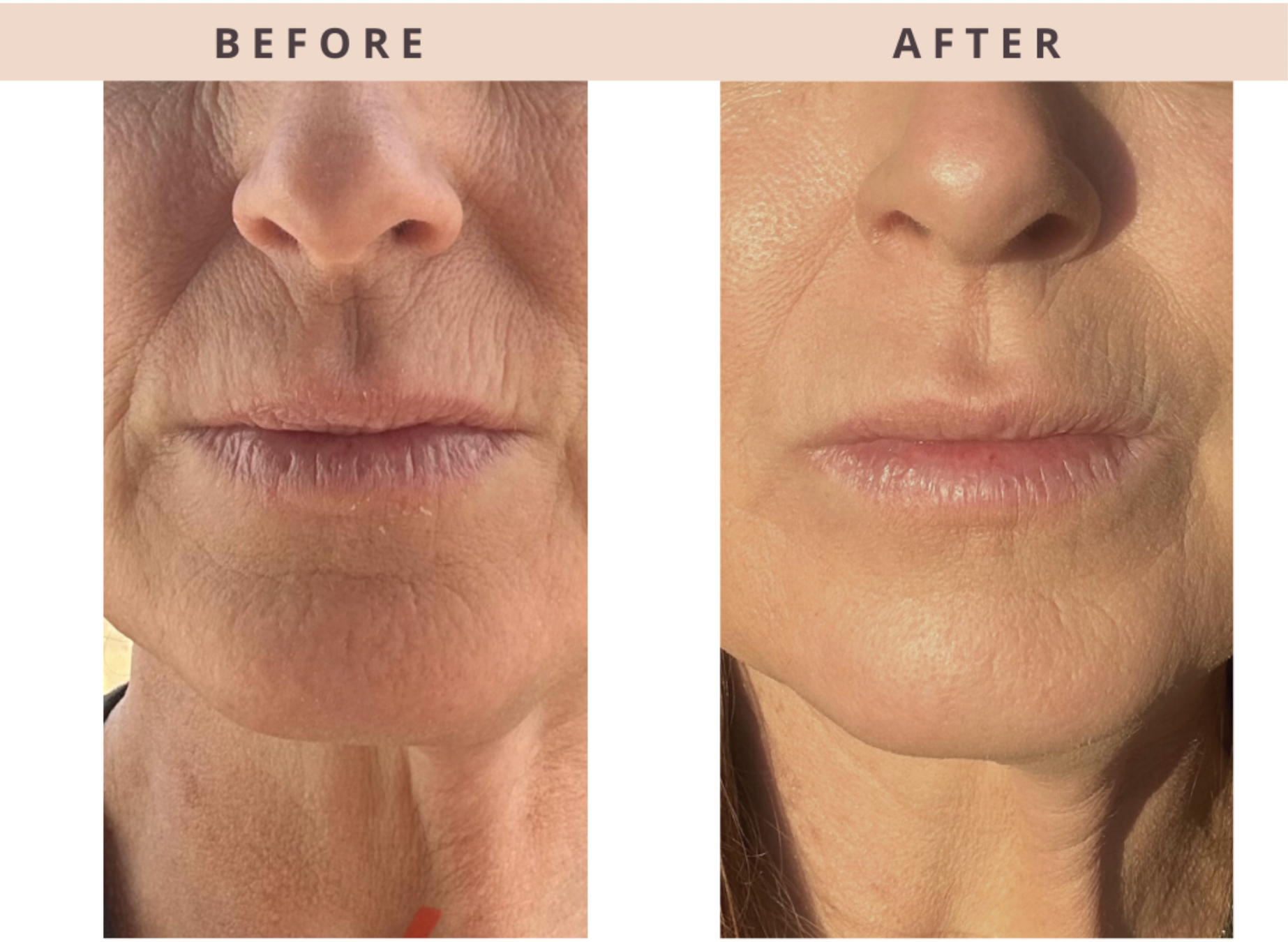 Before and after results of Virtue RF microneedling treatment